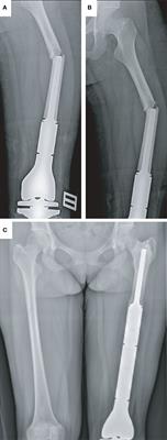 Revision surgery for periprosthetic fracture of distal femur after endoprosthetic replacement of knee joint following resection of osteosarcoma